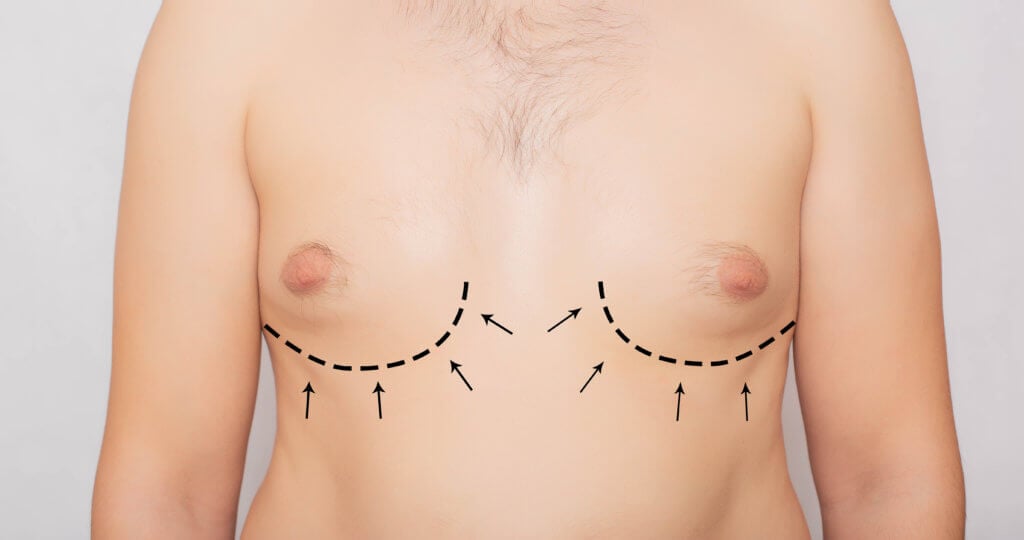 Male Breast Reduction: Exploring Gynecomastia Surgery